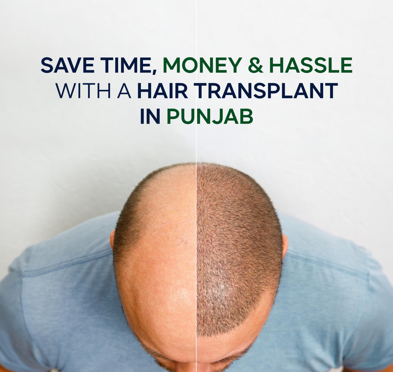 Skip the Long Journey and Get a Hair Transplant in Punjab
